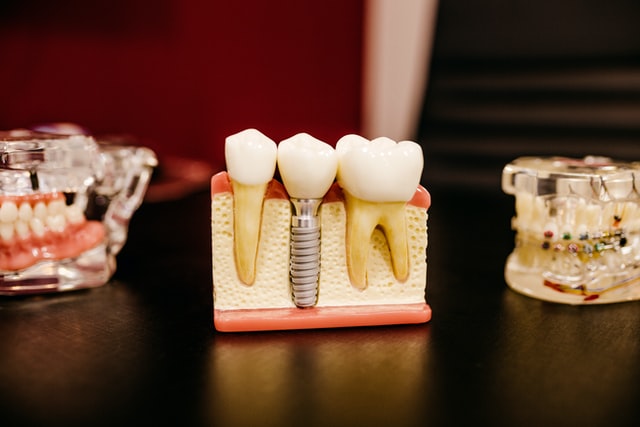 Cutaway view of a dental implant